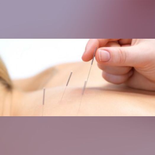 Dry Needling